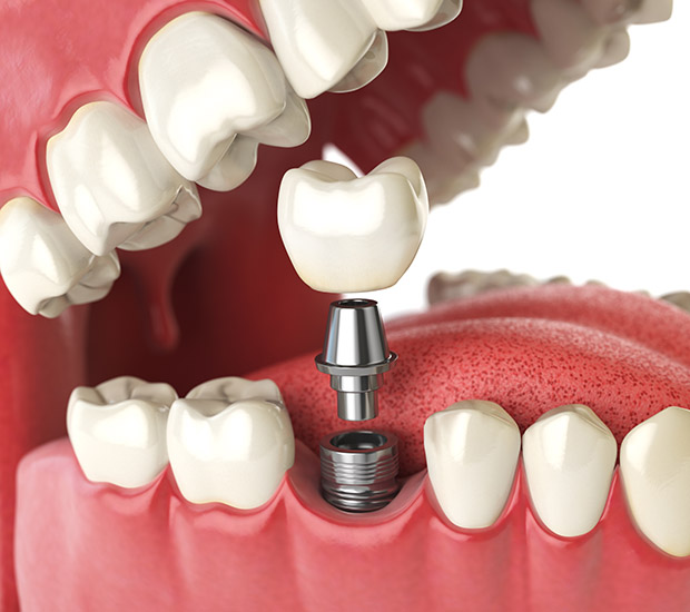 Laguna Hills Will I Need a Bone Graft for Dental Implants