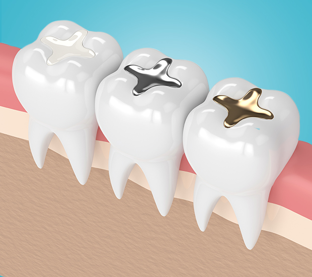 Laguna Hills Composite Fillings