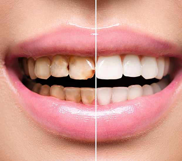 Laguna Hills Dental Implant Restoration