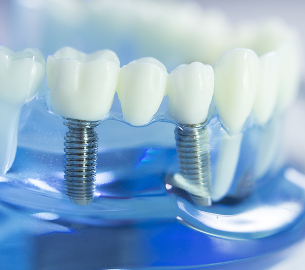 Laguna Hills Dental Implants