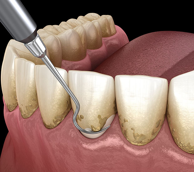 Laguna Hills Root Scaling and Planing