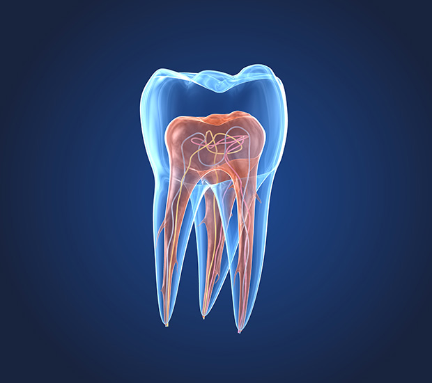 Laguna Hills What is an Endodontist